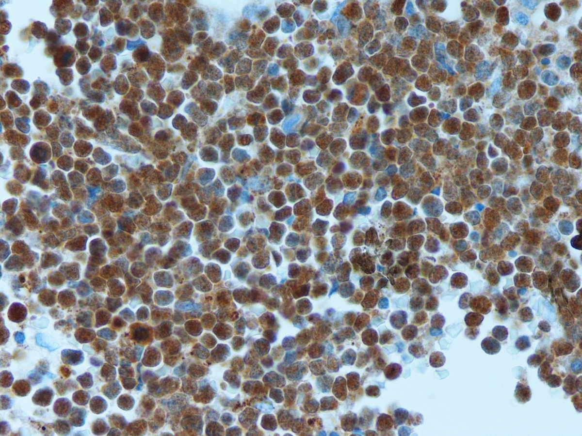 third bone marrow biopsy TdT